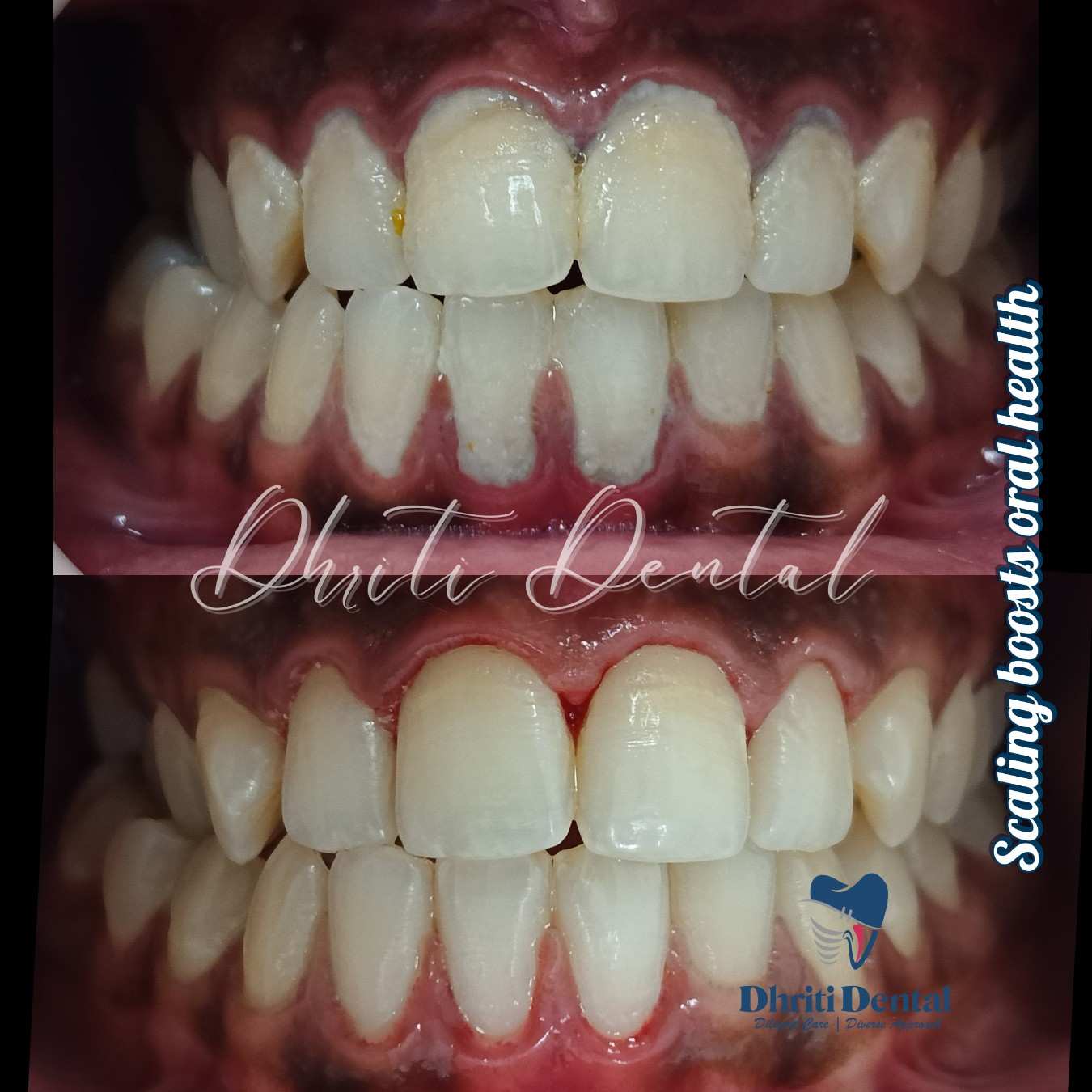 Teeth cleaning - before and after.